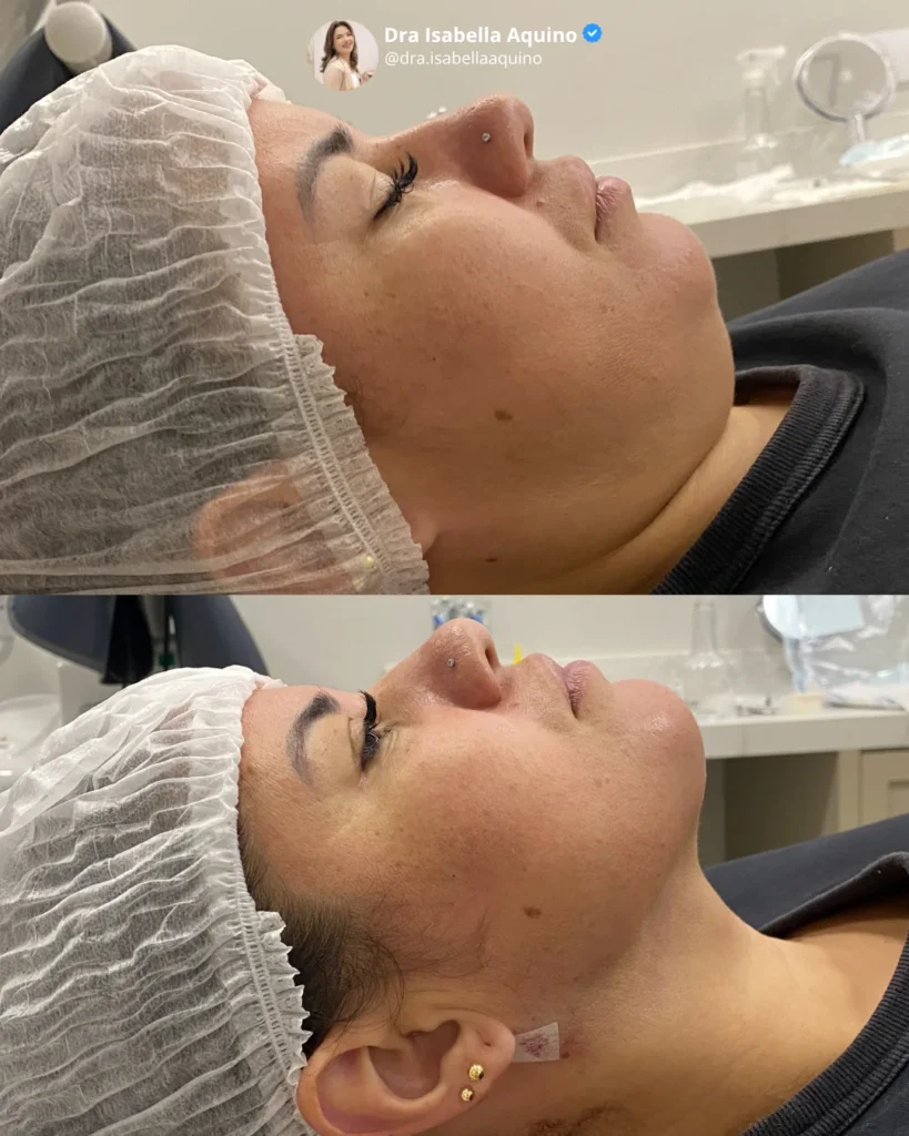 Antes e depois de lipo de papada em paciente da Dra. Isabella Aquino