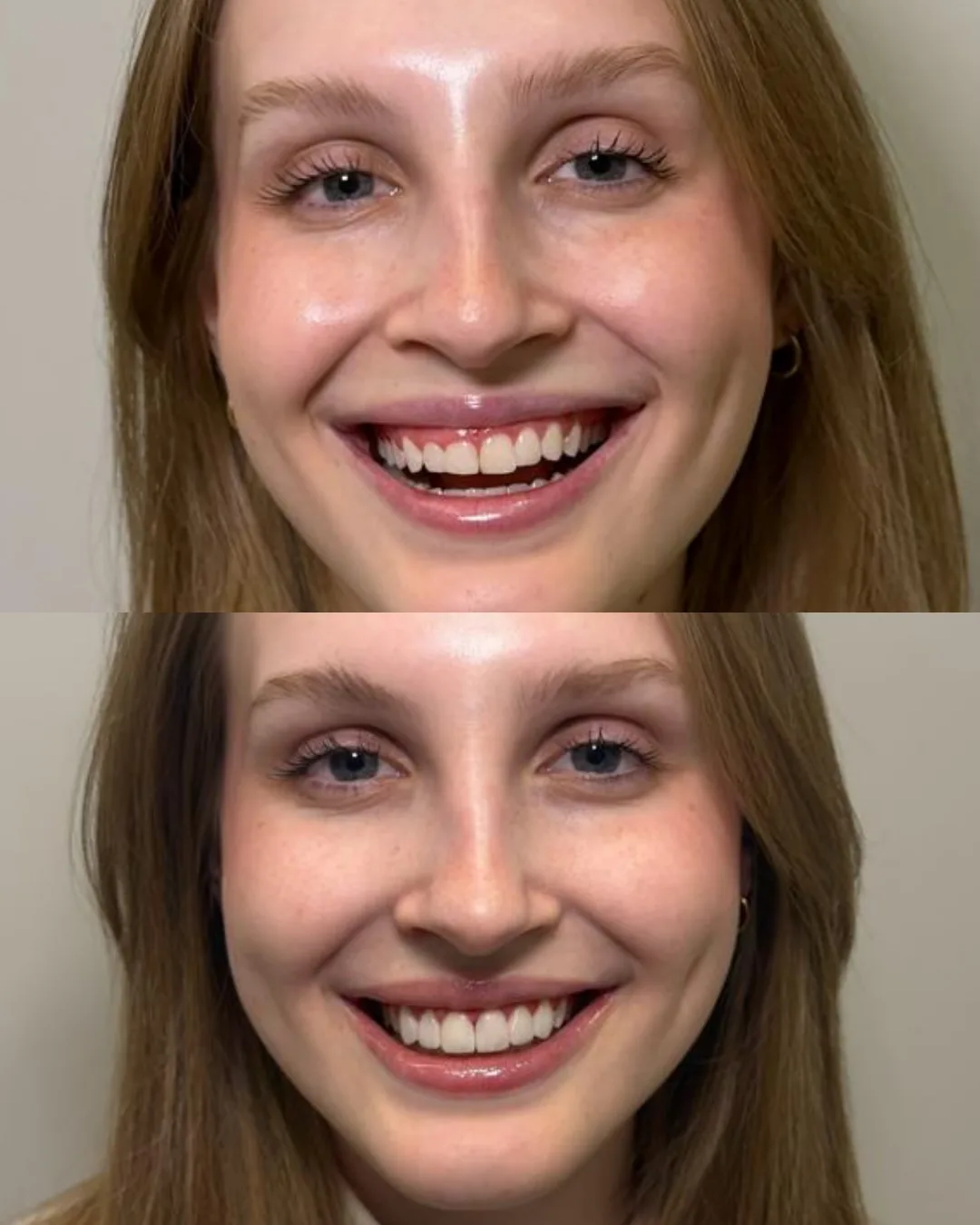 Sorriso de uma paciente da Dra. Isabella Aquino