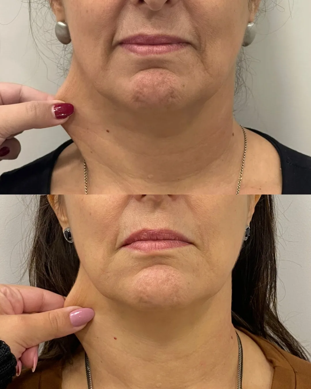 Antes e depois de bioestimulador de colágeno em paciente da Dra. Isabella Aquino