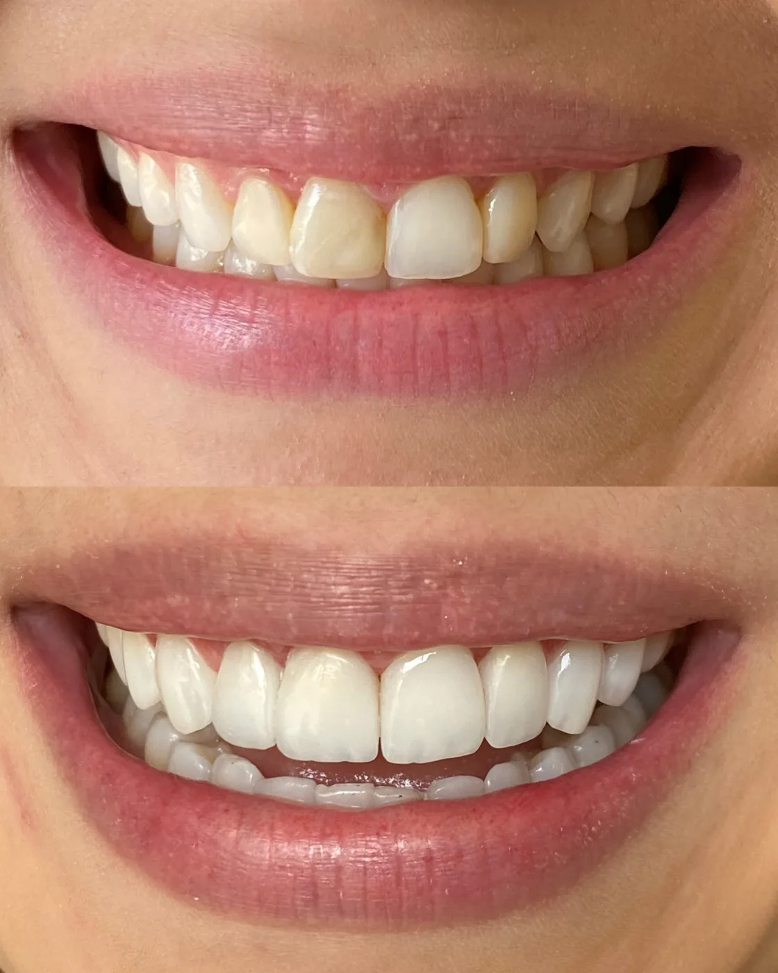 Close de um sorriso após tratamento com facetas