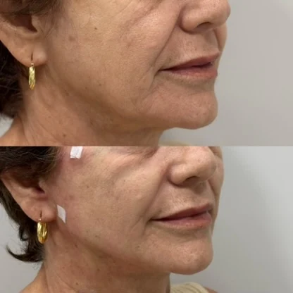 Antes e depois de fios de PDO em paciente da Dra. Isabella Aquino