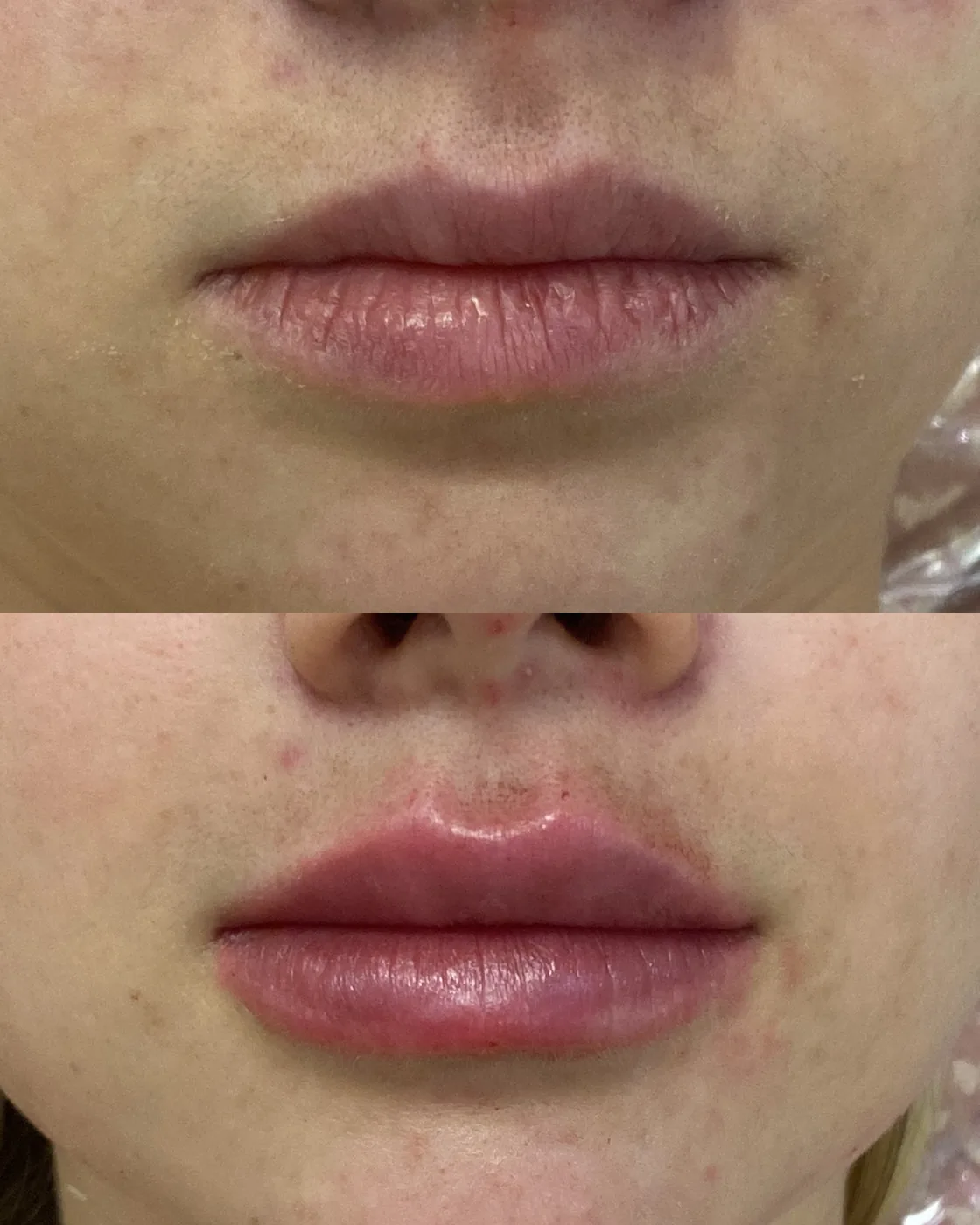 Antes e depois de preenchimento labial em paciente da Dra. Isabella Aquino