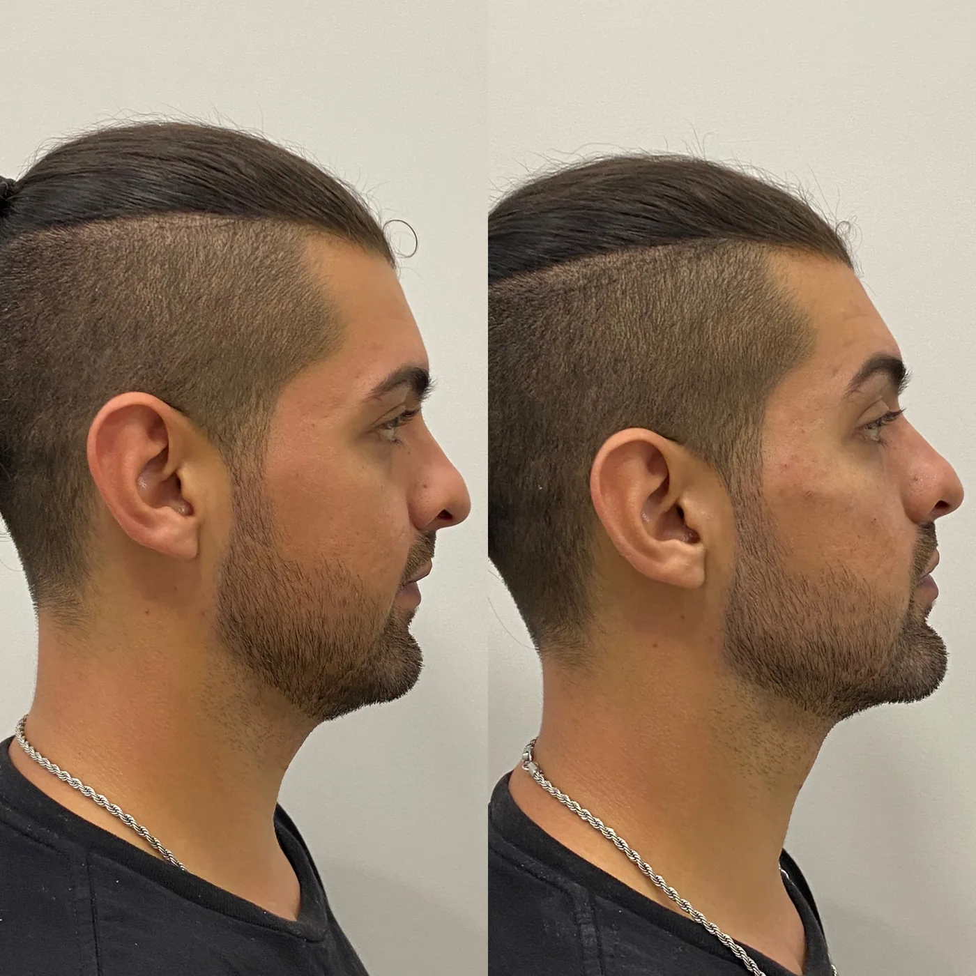 Antes e depois de preenchimento facial em paciente da Dra. Isabella Aquino