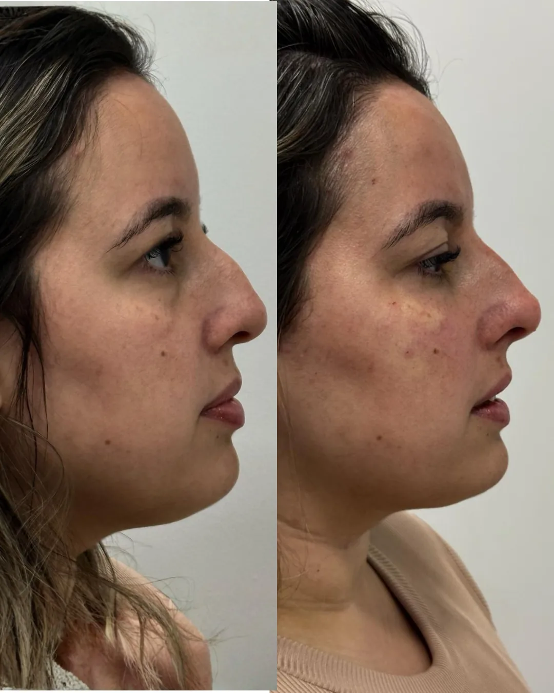 Antes e depois de rinomodelação em paciente da Dra. Isabella Aquino