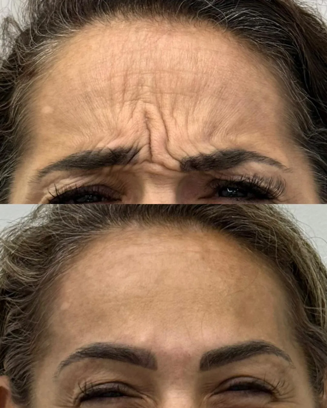 Antes e depois de toxina botulínica na testa de uma paciente da Dra. Isabella Aquino